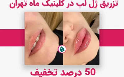 تزریق ژل لب