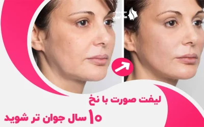 لیفت صورت با نخ