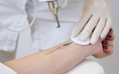 پاک کردن تاتو ابرو و بدن با دستگاه کیوسوئیچ در میرداماد