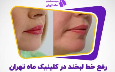 از بین بردن خط خنده