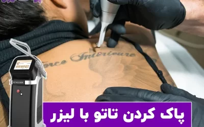 پاک کردن تاتو و خالکوبی با لیزر