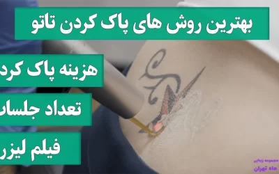 پاک کردن تاتو