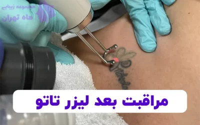 مراقبت های پس از لیزر تاتو