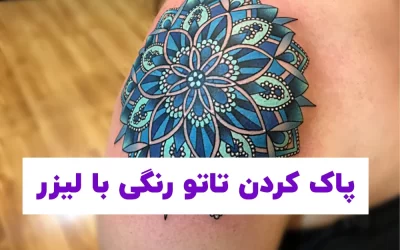 پاک کردن تاتو رنگی با لیزر