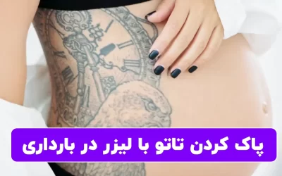 پاک کردن تاتو با لیزر در بارداری