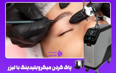پاک کردن میکروبلیدینگ با لیزر