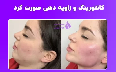 زاویه دهی و کانتورینگ صورت گرد با فیلر