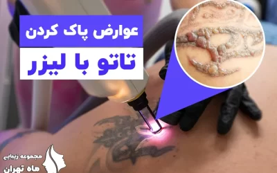 عوارض پاک کردن تاتو با لیزر