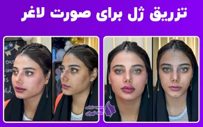 تزریق ژل برای صورت لاغر