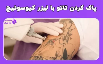 پاک کردن تاتو با لیزر کیوسوئیچ