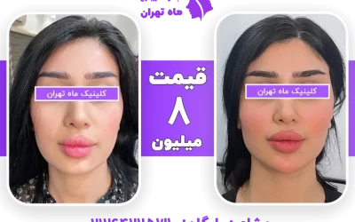 عکس فیلر صورت و عکس کانتورینگ صورت با قیمت 1405