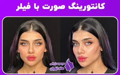 کانتورینگ موقتی صورت با فیلر + قیمت 1405 تهران