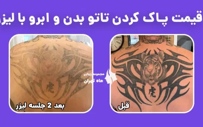 قیمت پاک کردن تاتو بدن و ابرو با لیزر
