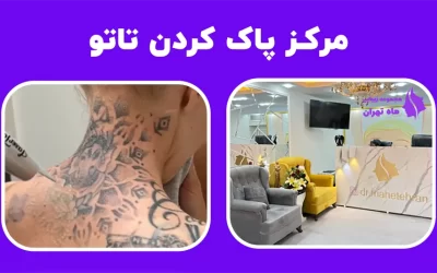 مرکز پاک کردن تاتو