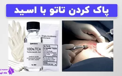 پاک کردن تاتو با اسید