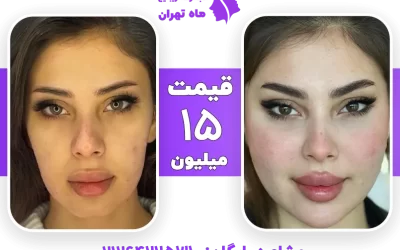 مرکز کانتورینگ صورت + لیست هزینه 1405 تهران