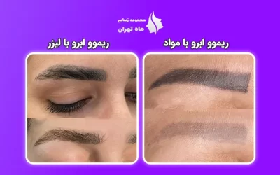 مقایسه ریموو ابرو با لیزر و مواد، کدامیک بهتر است؟