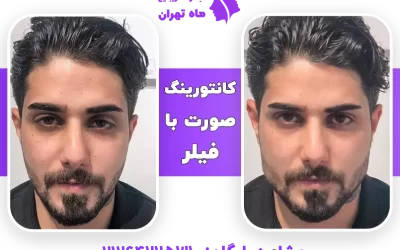 طراحی و کانتورینگ چهره با تزریق فیلر صورت + عکس قبل و بعد