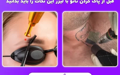 قبل از پاک کردن تاتو با لیزر این نکات را باید بدانید