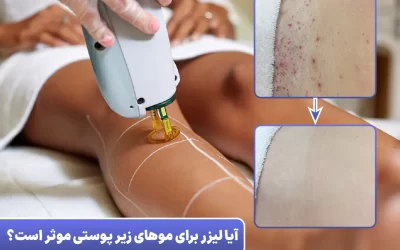 آیا لیزر موی زائد برای موهای زیر پوستی موثر است؟