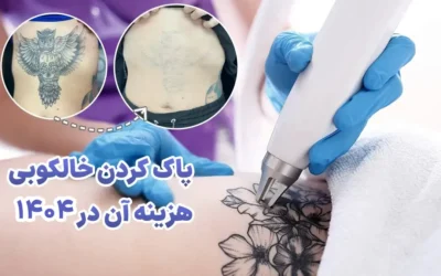 پاک کردن خالکوبی و قیمت آن در 1405 با فیلم عکس واقعی