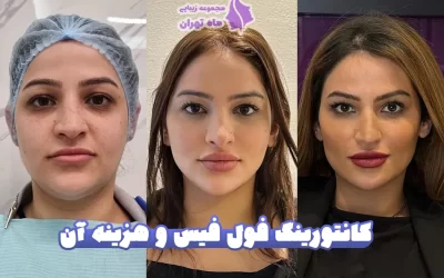 کانتورینگ فول فیس به همراه هزینه آن در سال 1405
