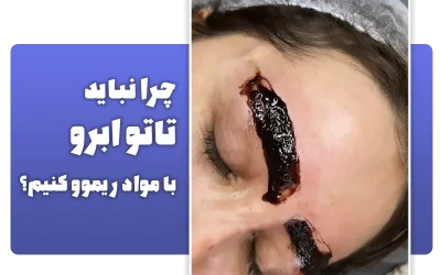 چرا نباید تاتو خود را در سالن های آرایشی پاک کنیم؟