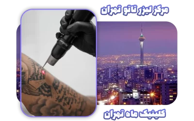 در تهران برای پاک کردن تاتو با لیزر به کجا مراجعه کنیم؟