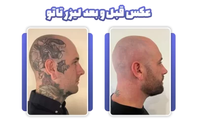 قبل و بعد لیزر تاتو عکس واقعی + فیلم