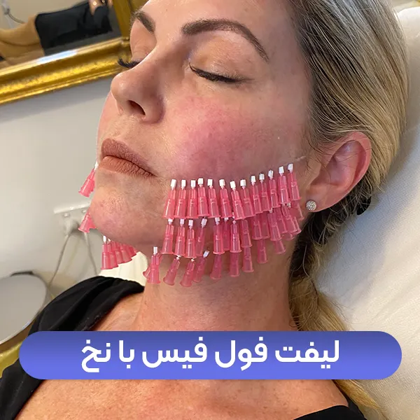 لیفت فول فیس صورت با نخ