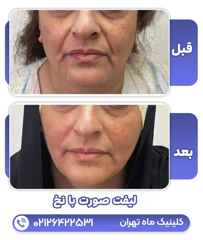 لیفت صورت با نخ