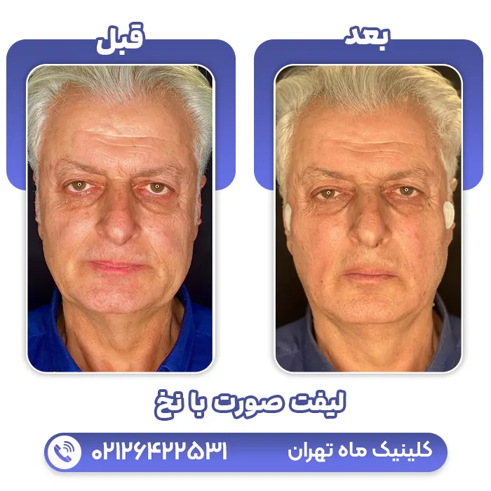 لیفت صورت با نخ
