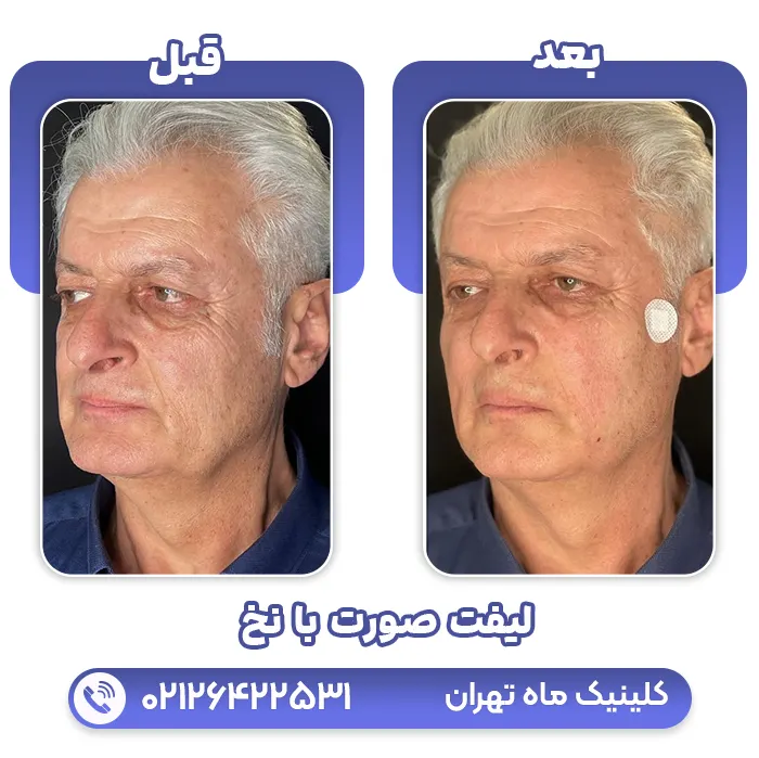 لیفت صورت با نخ