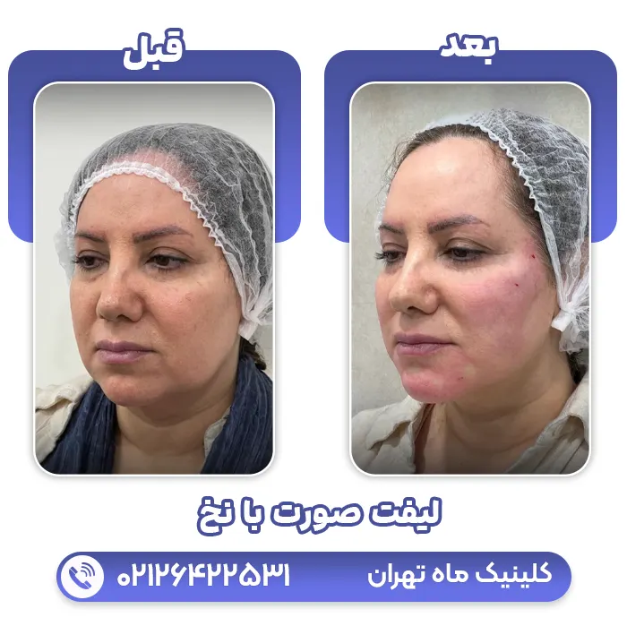 لیفت صورت با نخ