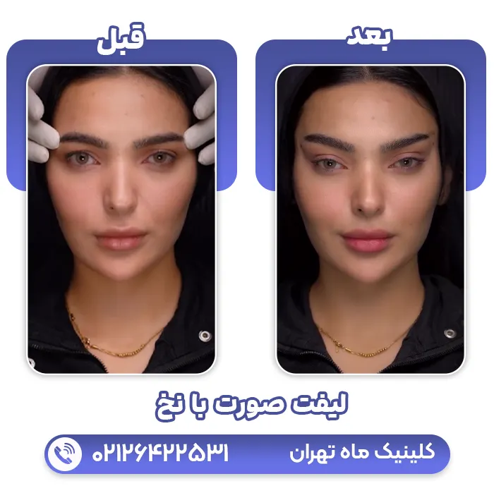 لیفت ابرو با نخ