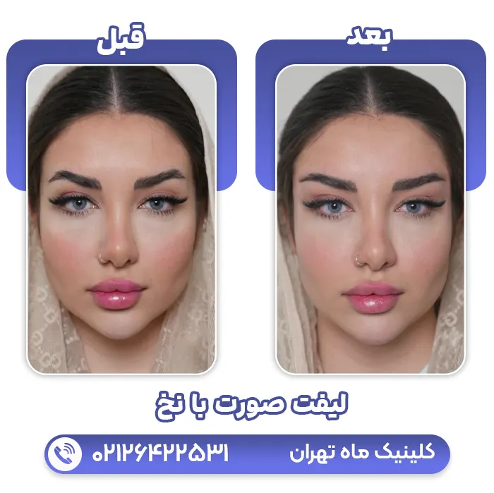 لیفت ابرو با نخ